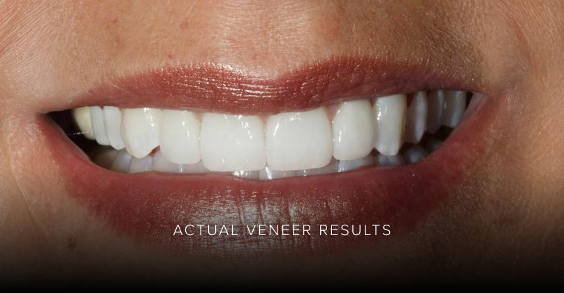 veneers results by advanced dentistry of blakeney