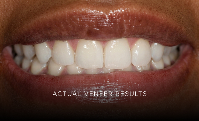 Actual veneer results