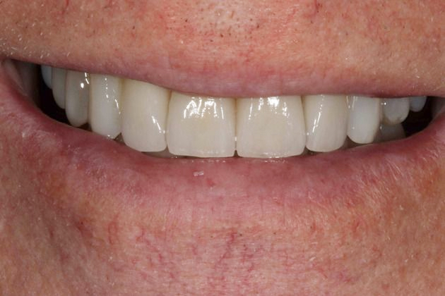 After smile makeover