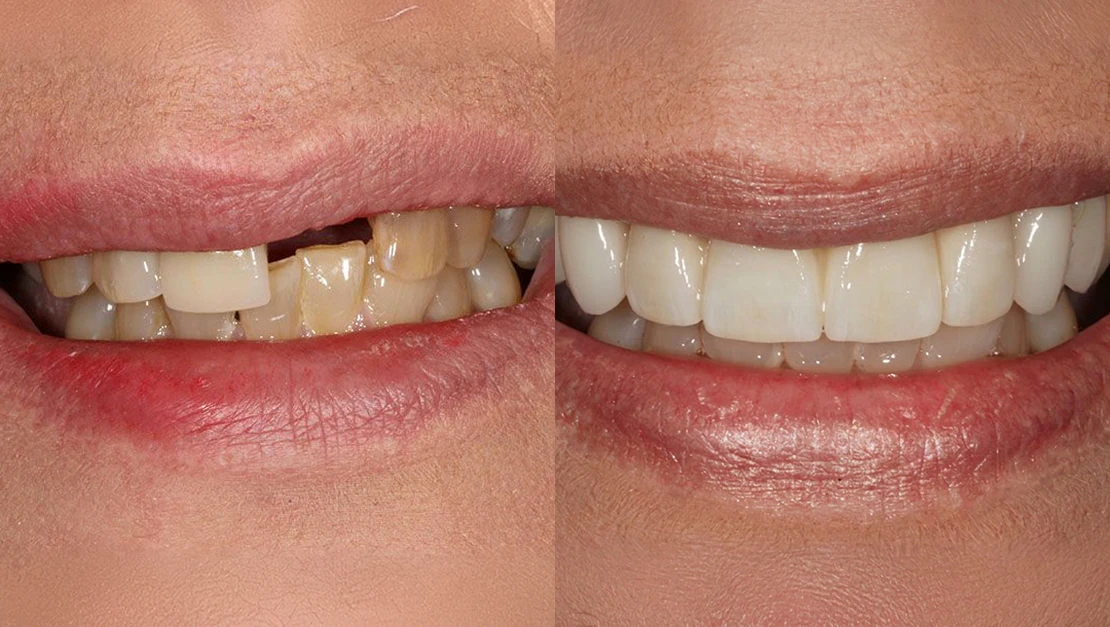 Before and after images from dental implants procedure
