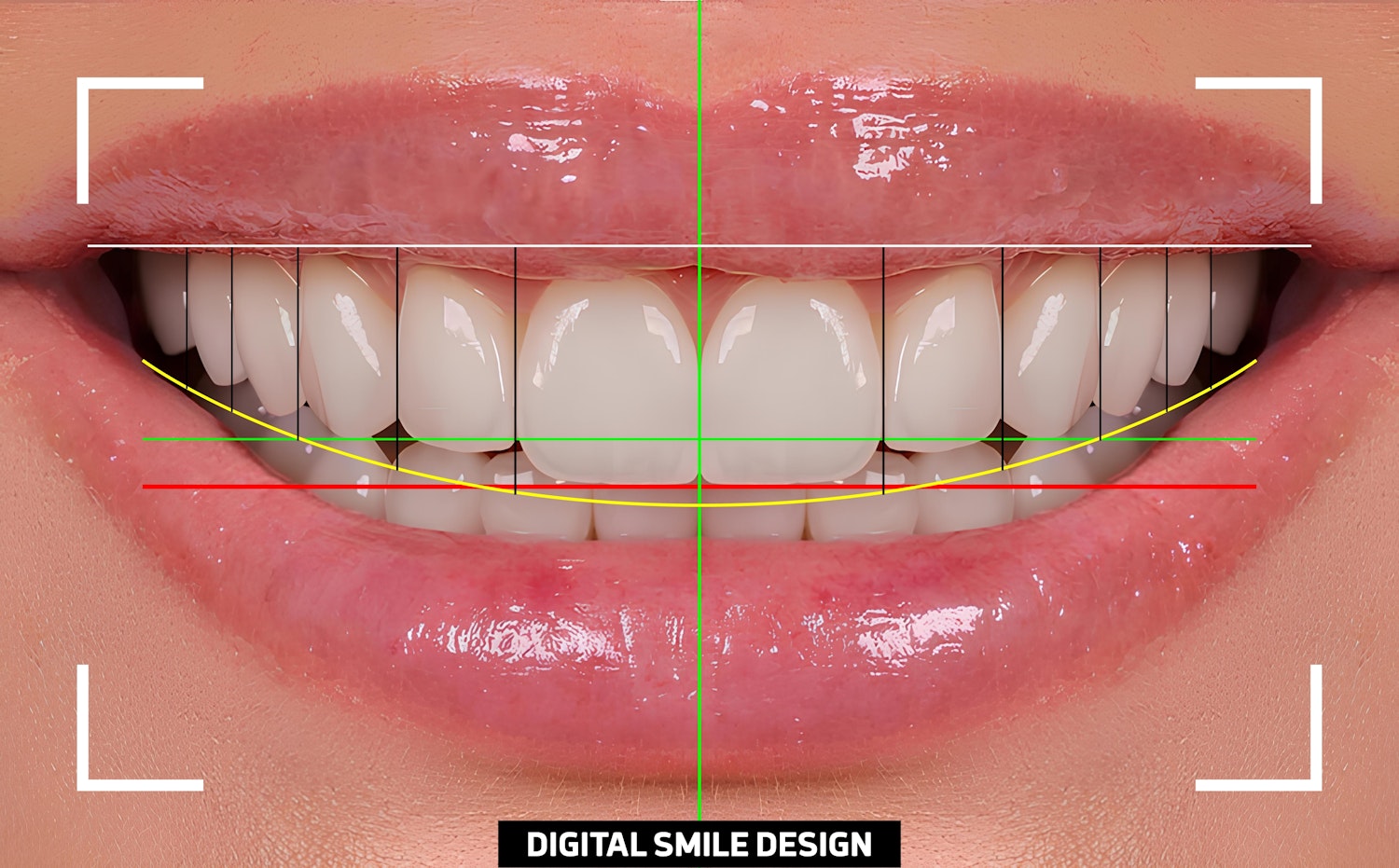 Digital smile design