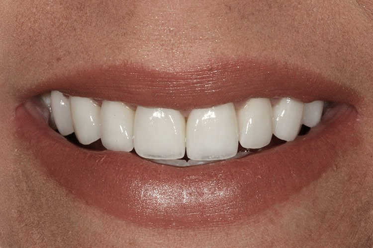 Advanced Dentistry of Blakeney patient after a smile makeover