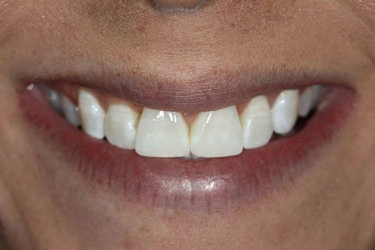 Advanced Dentistry of Blakeney patient before a smile makeover