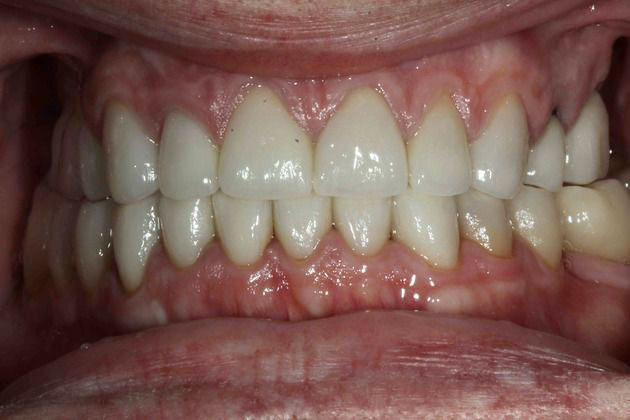 After crown placement