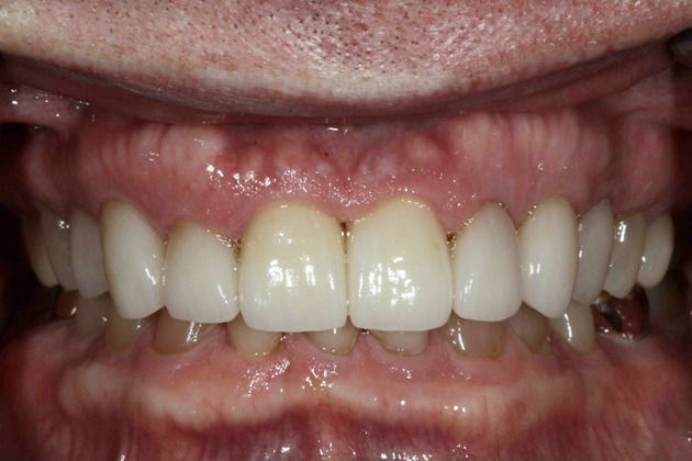After Implants