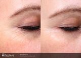 picosure procedure before and after