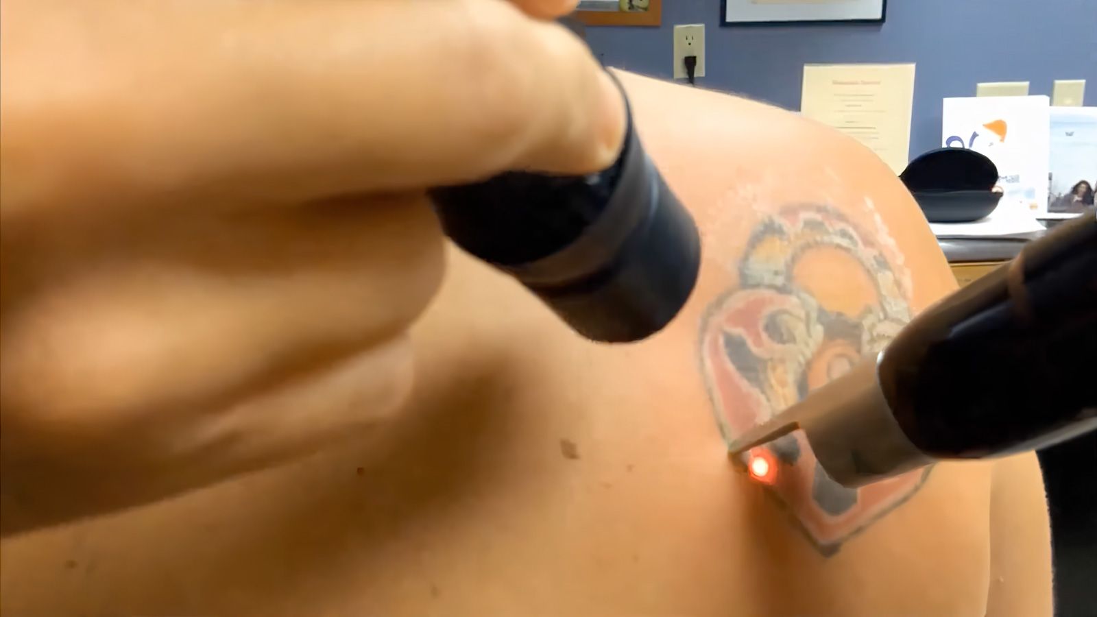 How Effective Is Laser Tattoo Removal  Reno Sparks Medspa