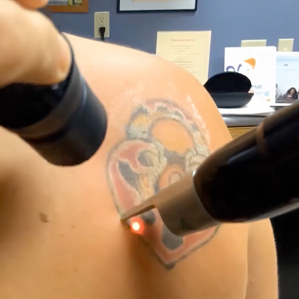 PicoSure being used on skin