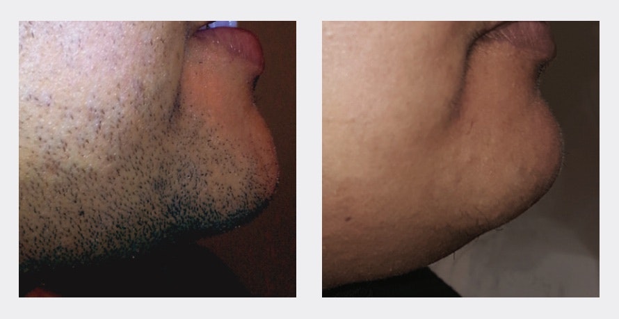 Before and after laser hair removal