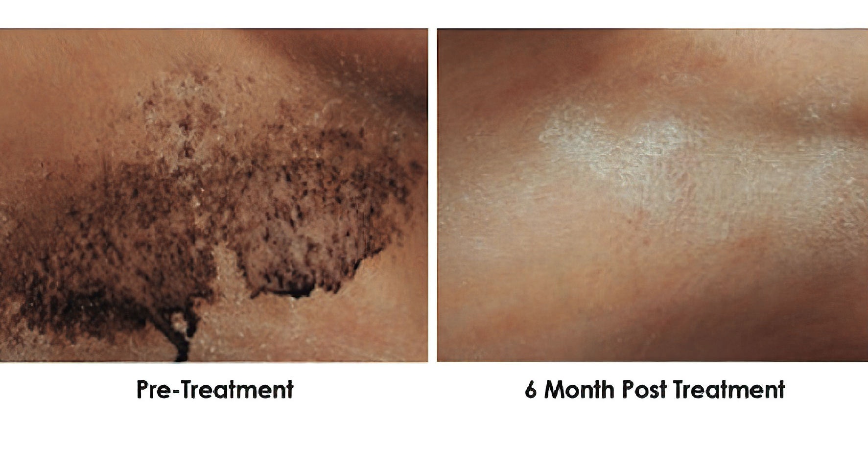 an armpit before and six months after PrecisionTx treatment