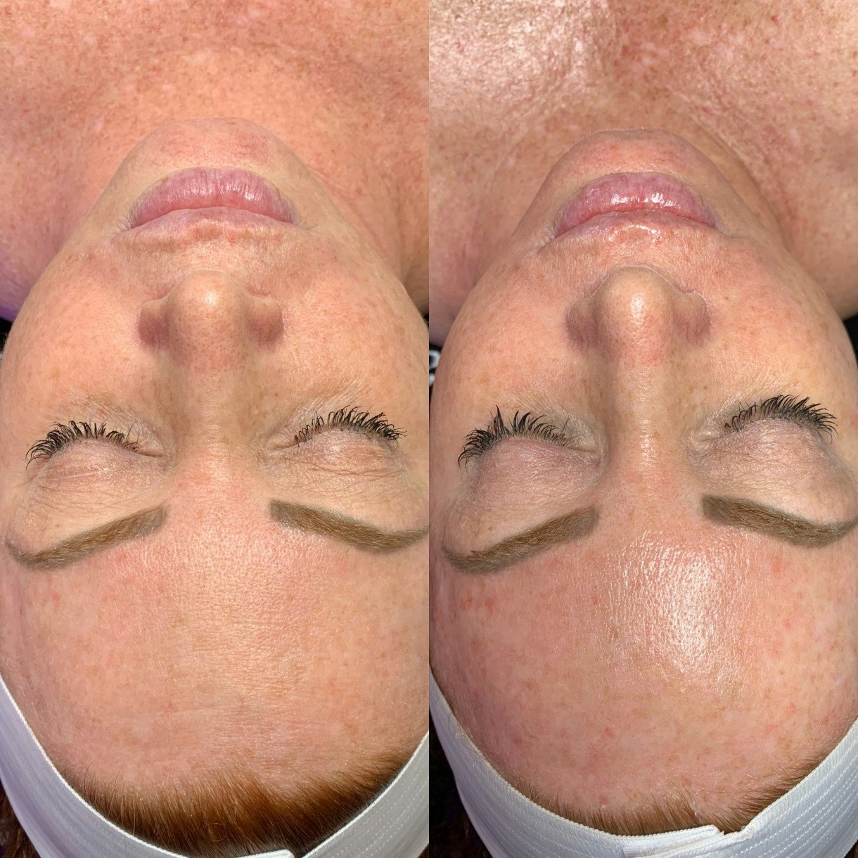 Patient before and after a HydraFacial treatment