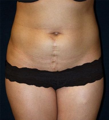 Before Tummy Tuck Surgery
