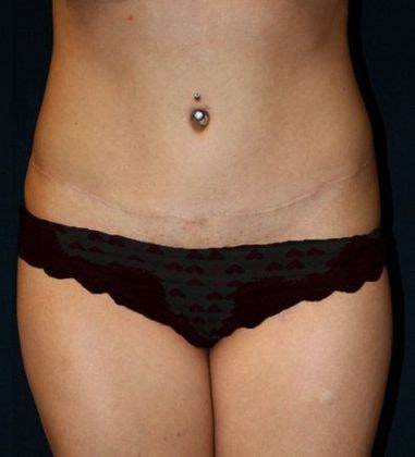 After Tummy Tuck Surgery