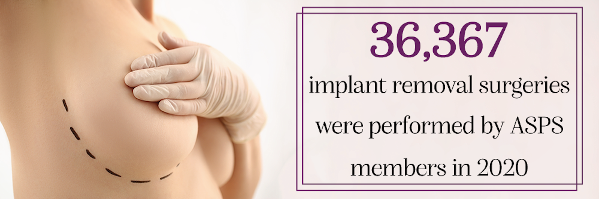 infographic that reads "36,367 implant removal surgeries were performed by ASPS members in 2020"
