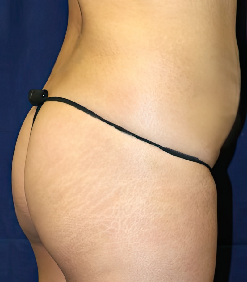 Buttock Implants in Reno  Expert Buttock Augmentation Surgeon