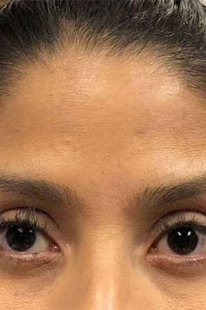 After BOTOX Cosmetic