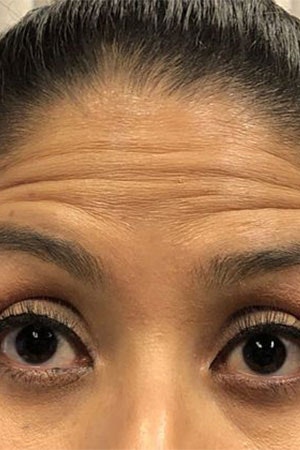 Before BOTOX Cosmetic