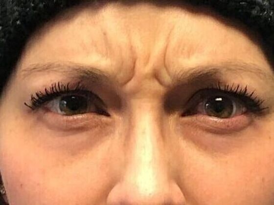 Before BOTOX® photo