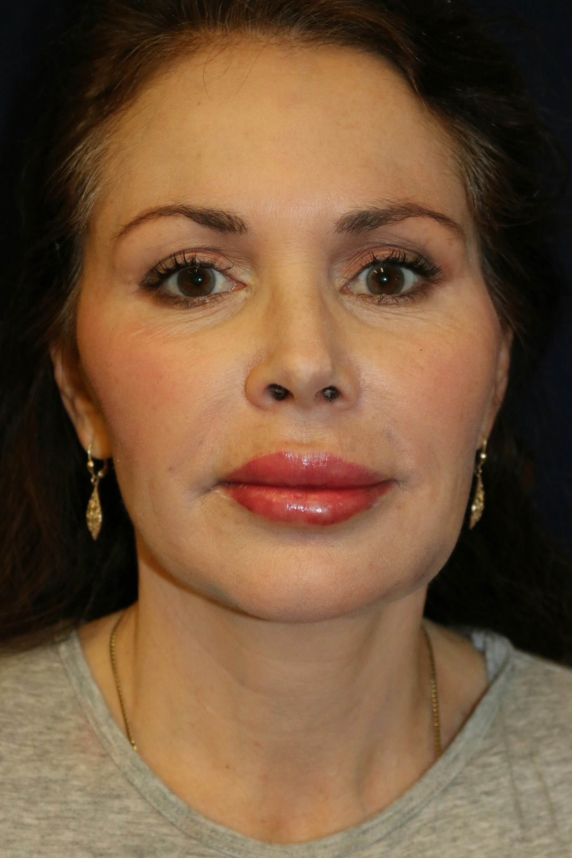 After JUVÉDERM VOLUMA and JUVERDERM ULTRA-PLUS