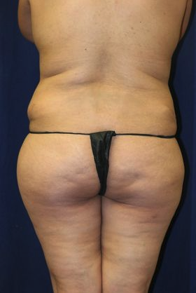 Before Brazilian butt lift