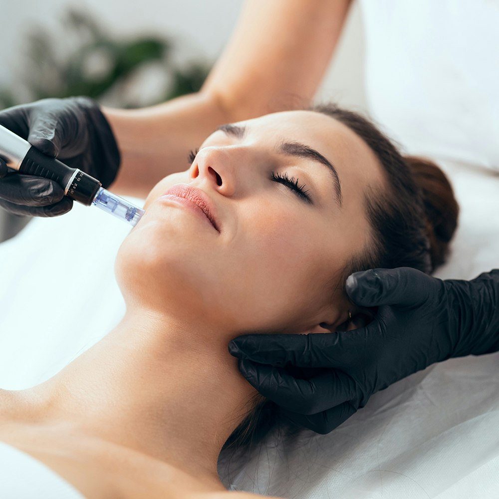 Woman receiving microneedling treatment