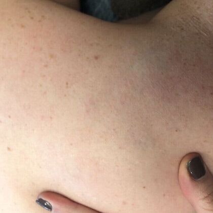 Same area after PicoSure laser tattoo removal