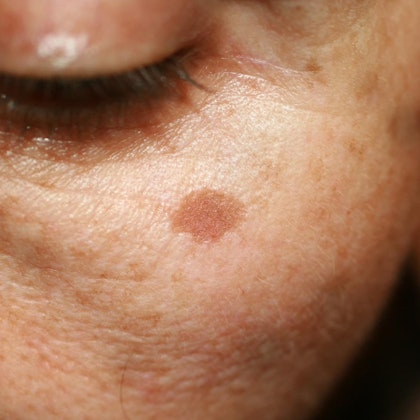 Age spot on woman's cheek