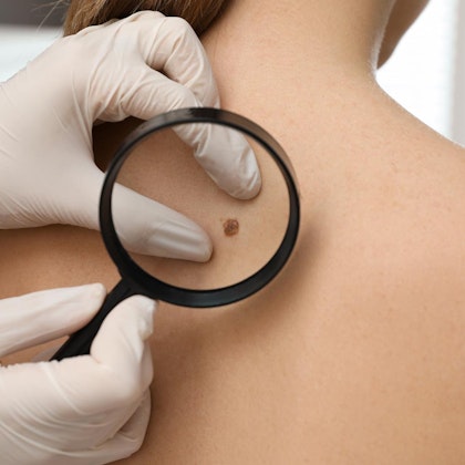 Birthmark under magnifying glass