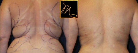 Dr. Murphy's patient before and after back liposuction