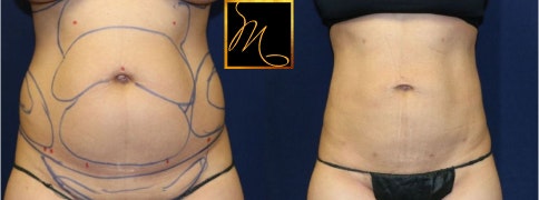 Patient before and after abdominal liposuction