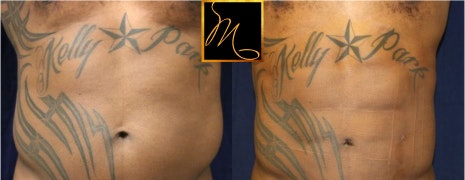 Dr. Murphy's patient before and after abdominal liposuction