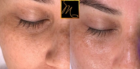Dr. Murphy's patient before and after a Hydrafacial
