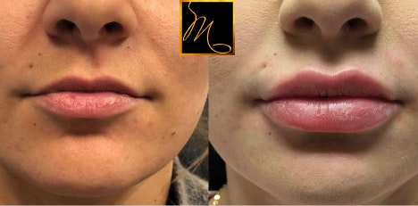 Dr. Murphy's patient before and after lip injections