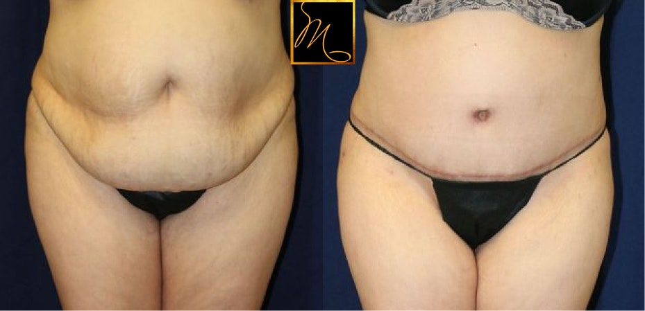 tummy tuck before and after in reno