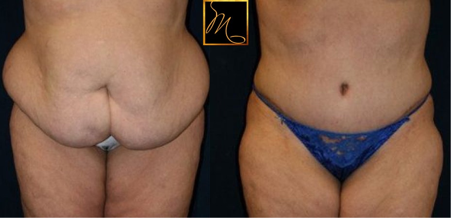 tummy tuck transformation in reno