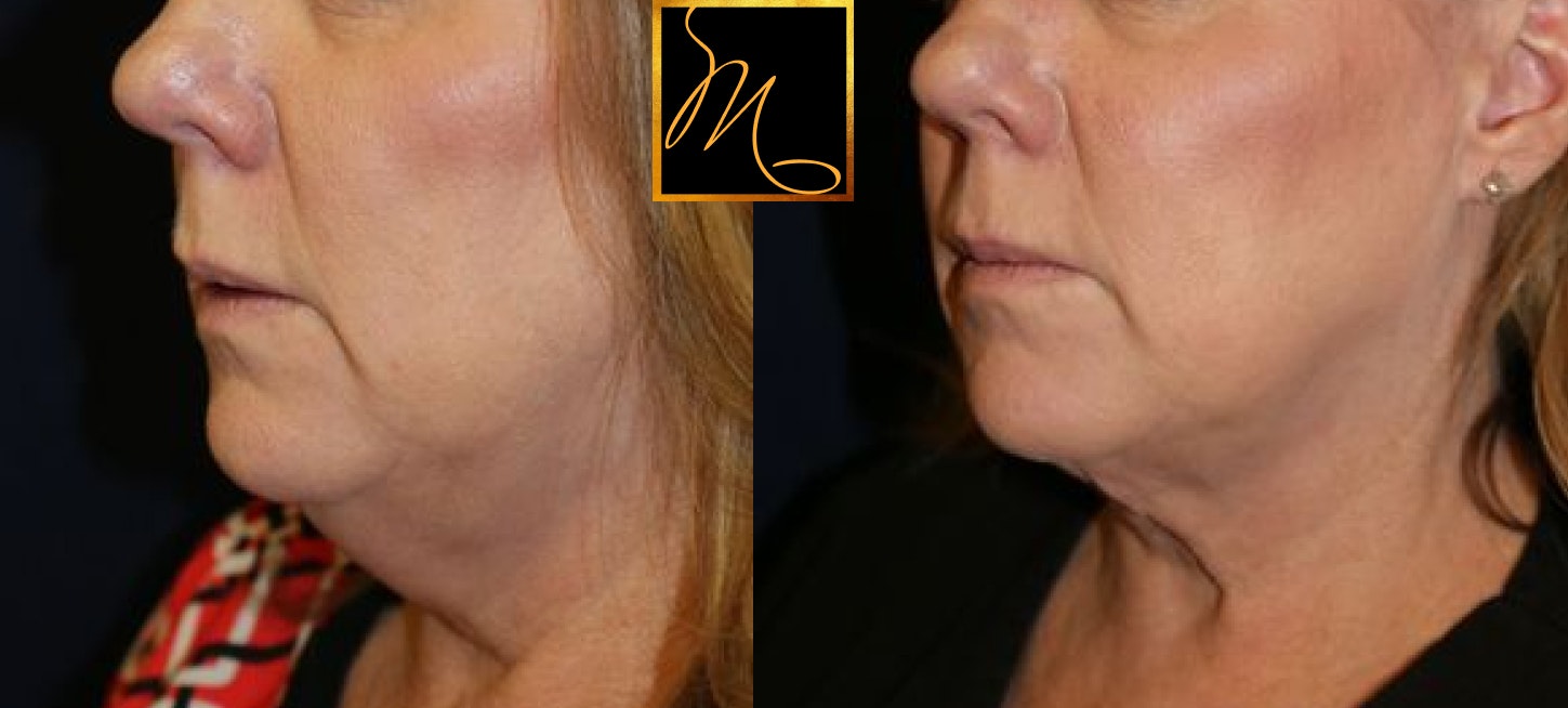 patient before and after KYBELLA