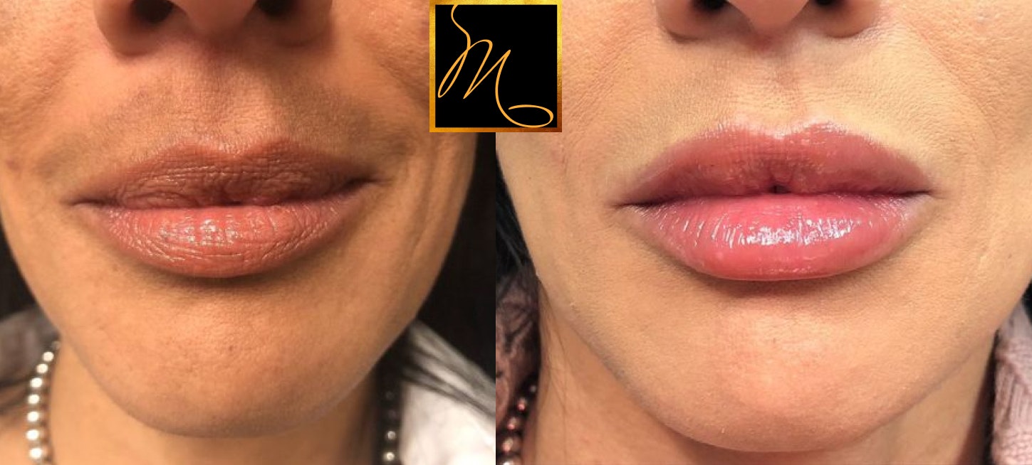 patient before and after lip filler