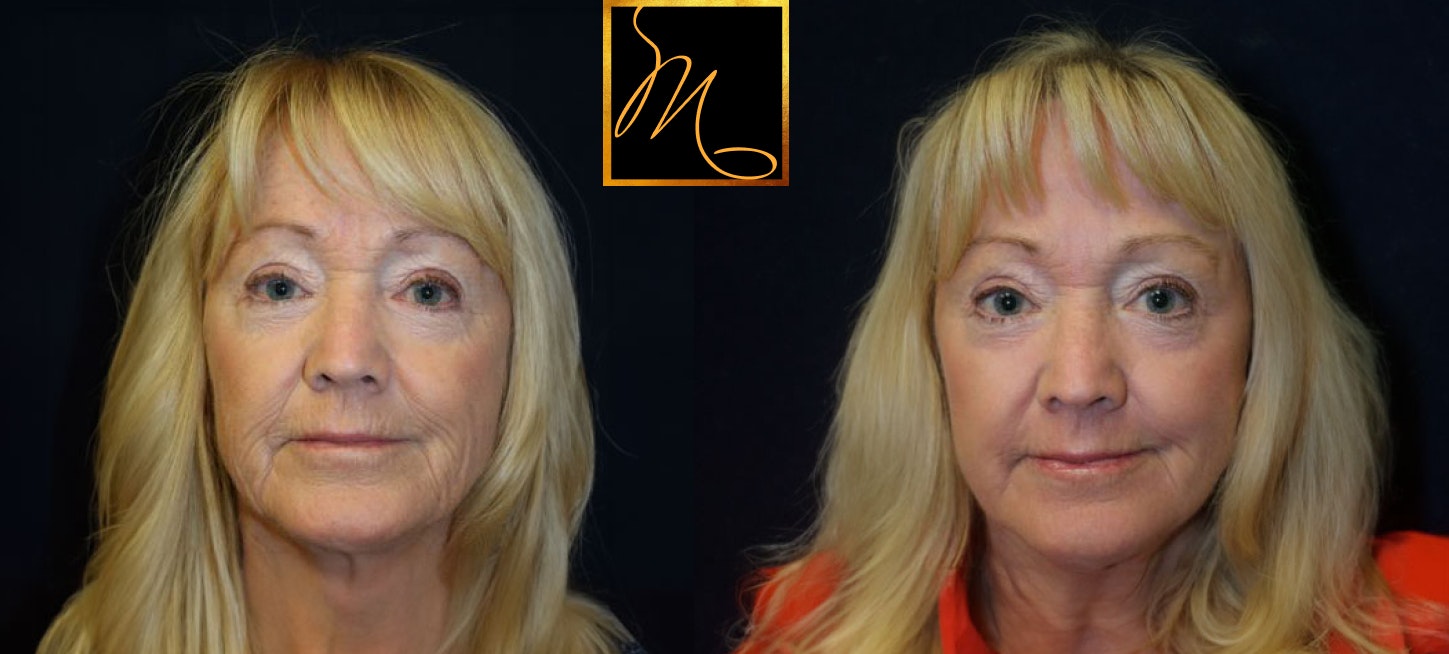 patient before and after CO2 therapy