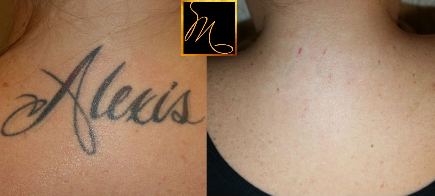 patient before and after tattoo removal