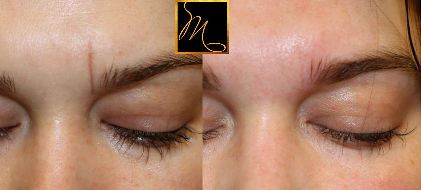 patient before and after scar therapy