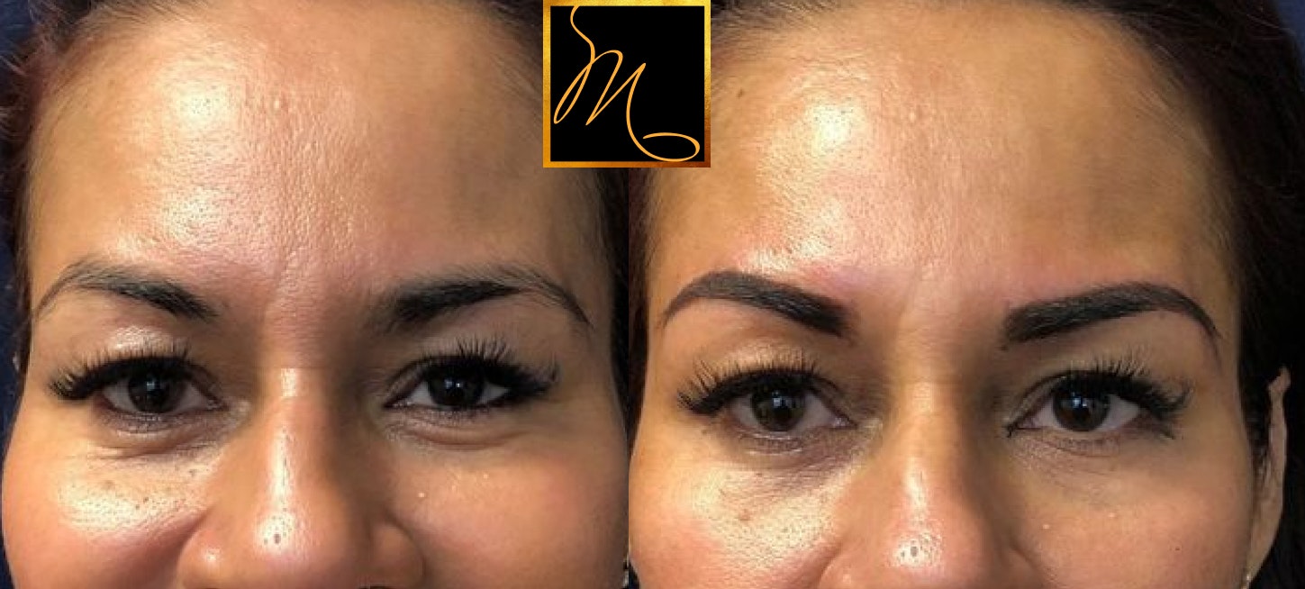 before and after cosmetic tattooing