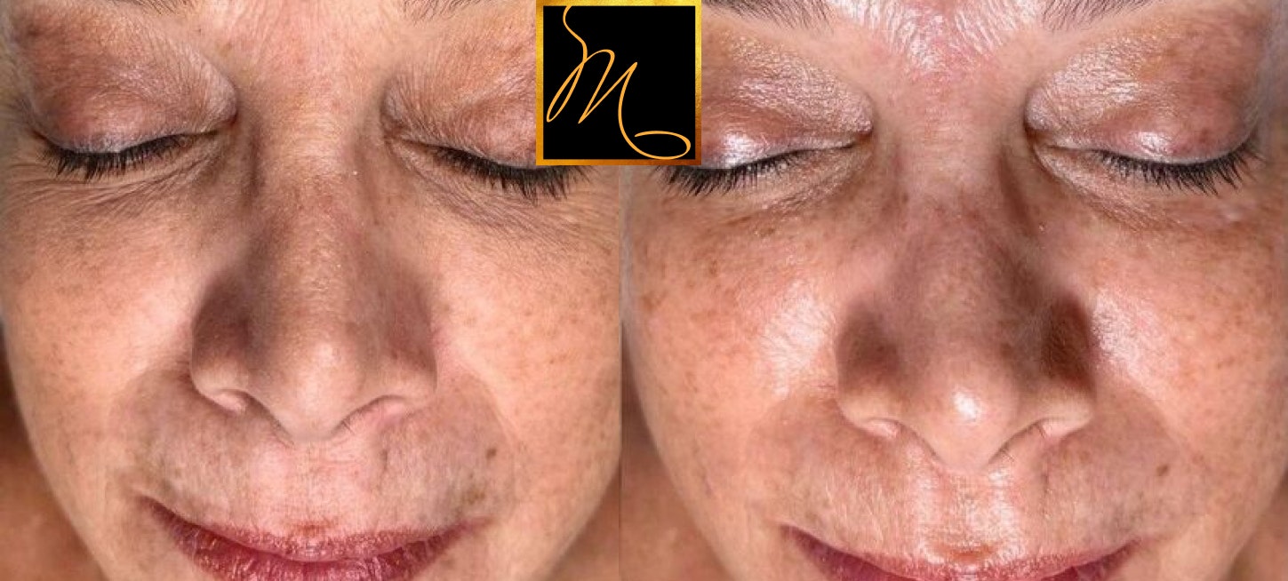 patient before and after facial