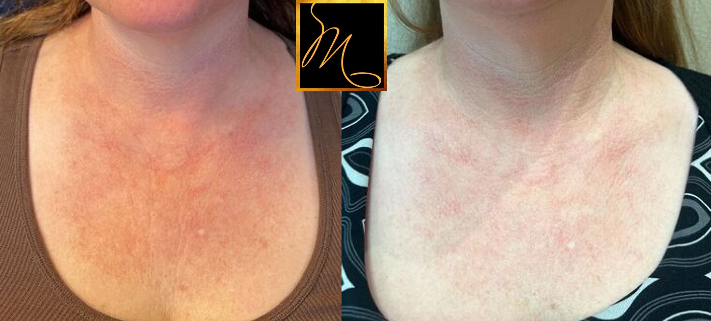patient before and after IPL