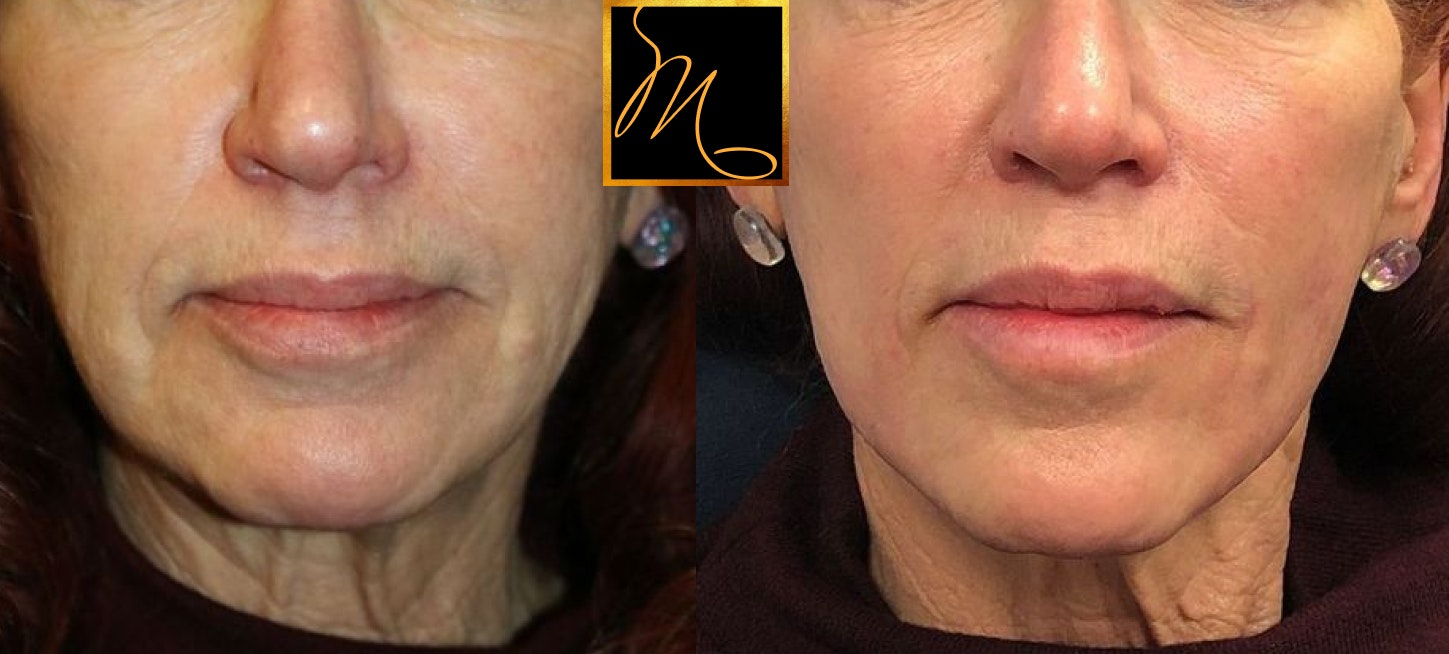 patient before and after thread lift