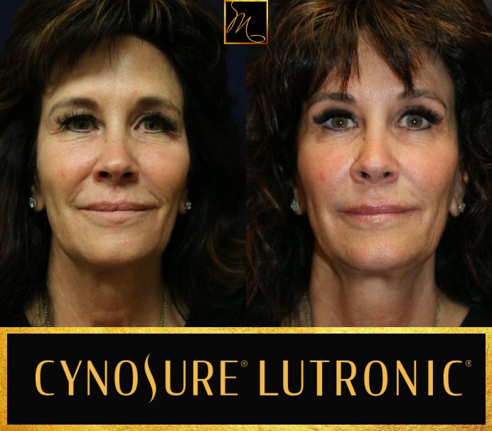 patient before and after Potenza microneedling
