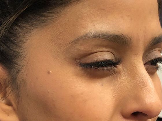 After BOTOX Cosmetic