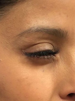 After BOTOX Cosmetic