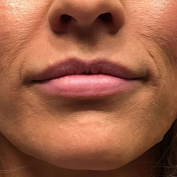 After lip augmentation