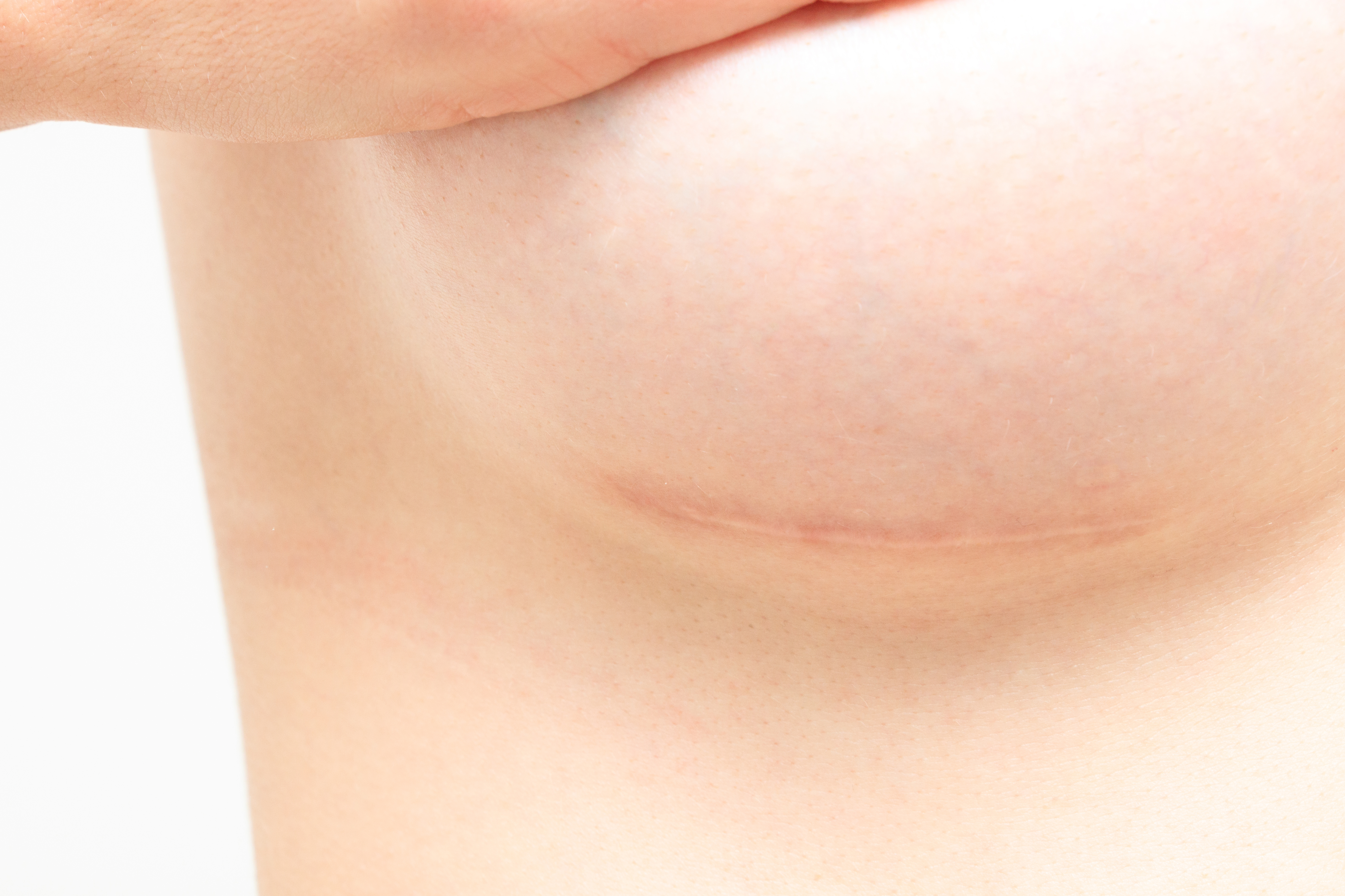 healing breast surgery scar