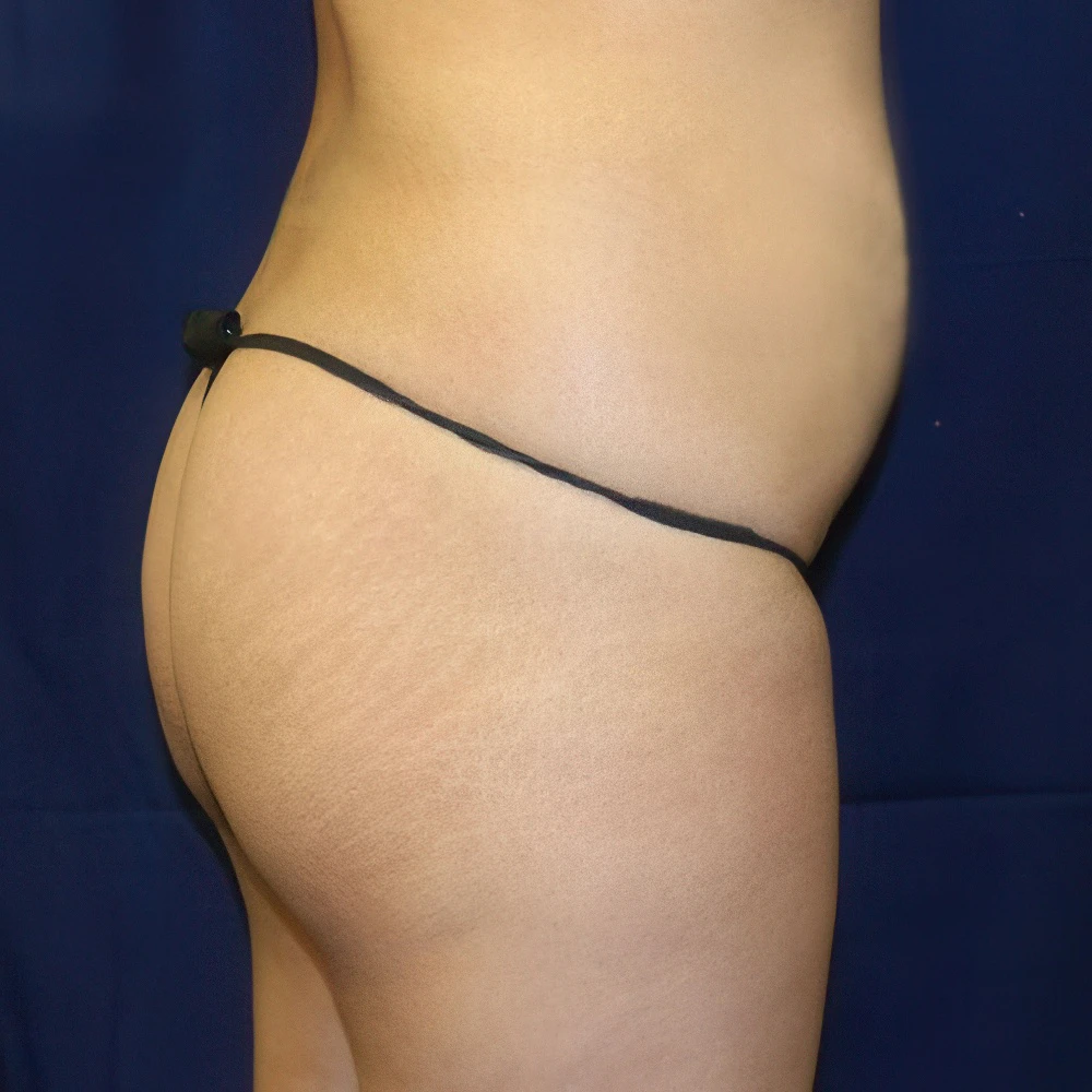 Case 2 before Brazilian Butt Lift with Dr. James E. Murphy